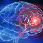 brain stroke